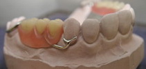 бюгельный протез стоматологические услуги