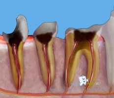 лечение зубов разрушенных