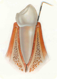 стоматологические услуги лечение пародонтита
