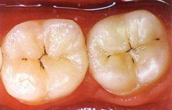 Кариес осложнения лечение зубов