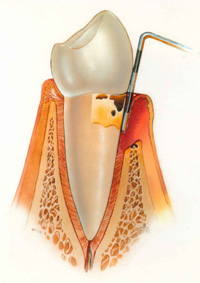 лечение пародонтоза стоматологические услуги
