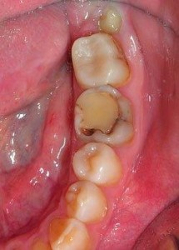 Кариес осложнение лечение зубов