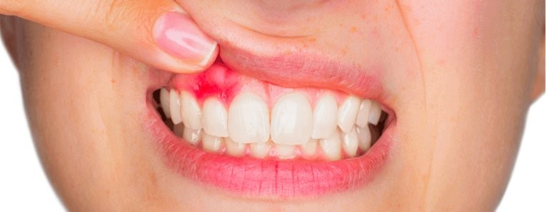 Киста зуба лечение воронеж