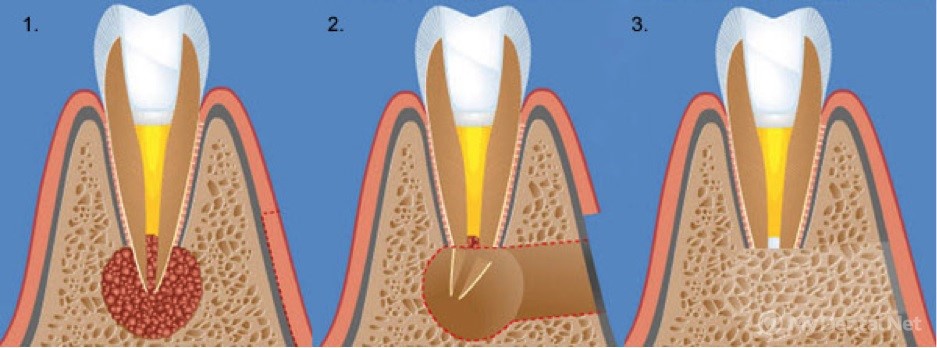 Киста зуба лечение воронеж